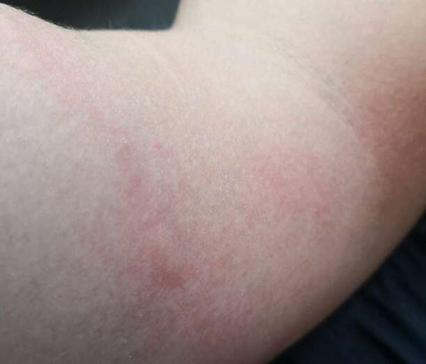 Imagen de un afectado por picadura de medusas en el canal a nado de Telde / TA